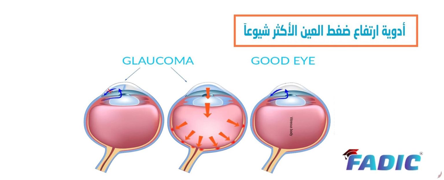 أدوية إرتفاع ضغط العين الأكثر شيوعاَ
